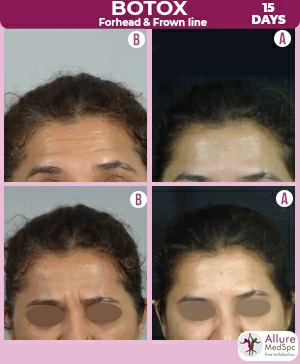 Botox_Forehead-line_frown