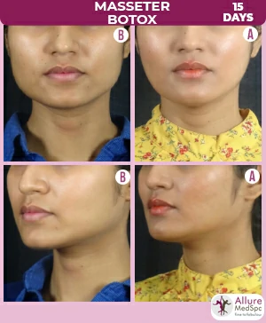 Masseter_Botox