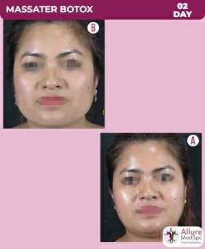 botox-treatment-before-after-image