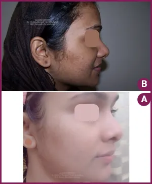 Dr.Shweta-best-four-PigmentationBA-image-1