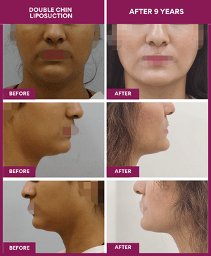 Female-Double-Chin-Liposuction