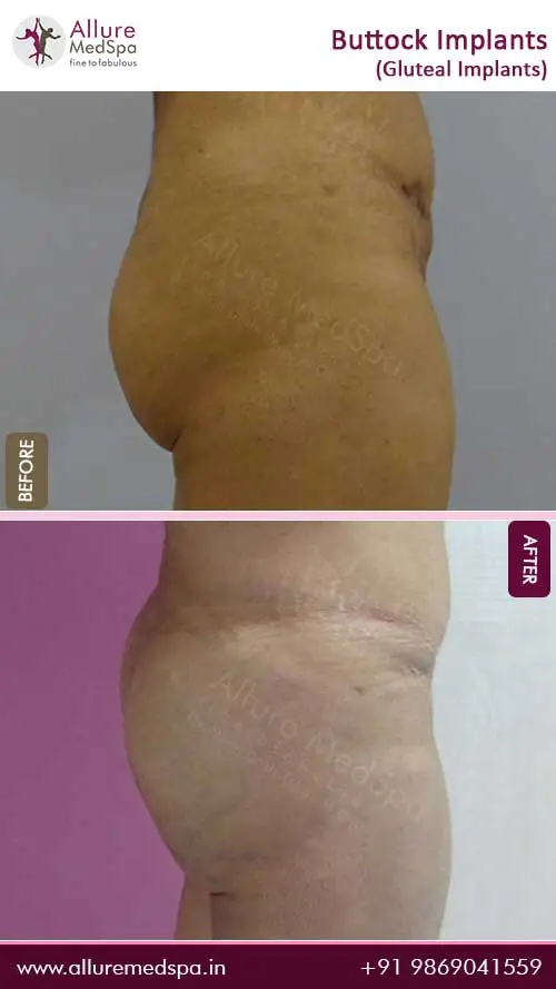 Gluteal-Buttock-Implants-Before-After-Images-Mumbai-India