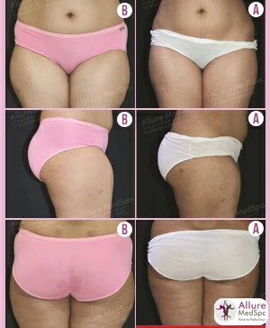 lipo-back