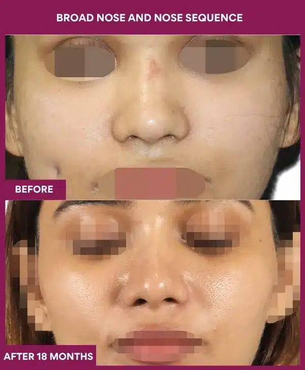 Broad Nose Before After Images in Mumbai, India
