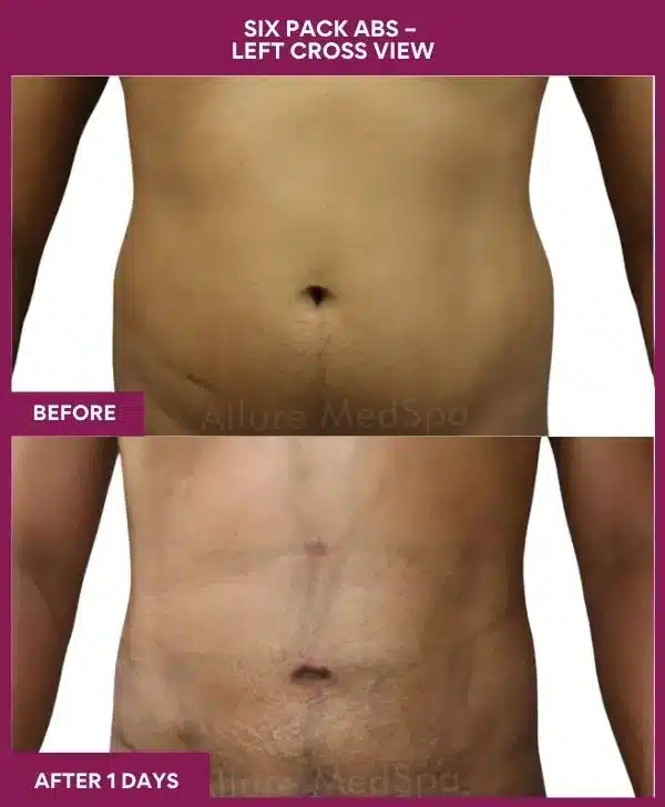 11-10-9-Six Pack Abs