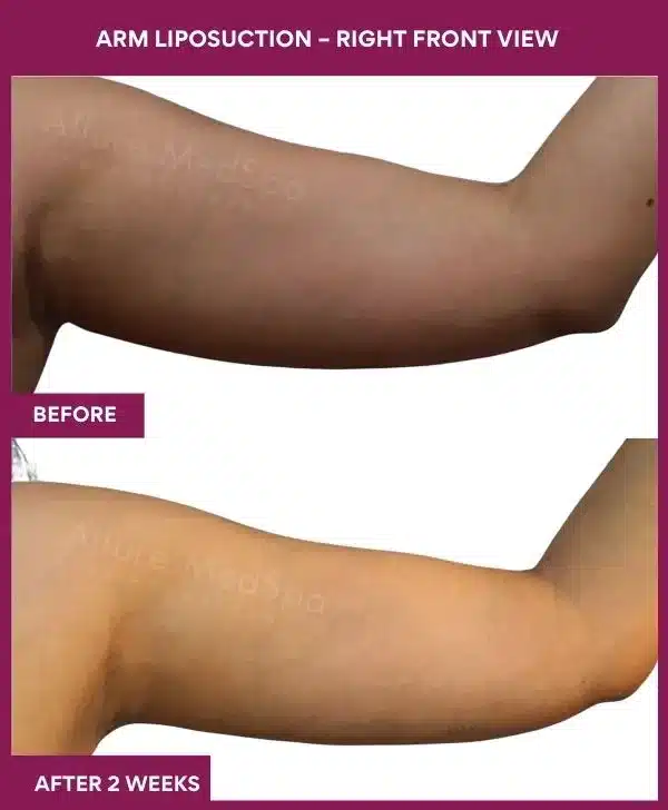 15 Arm Liposuction – Right Front View-