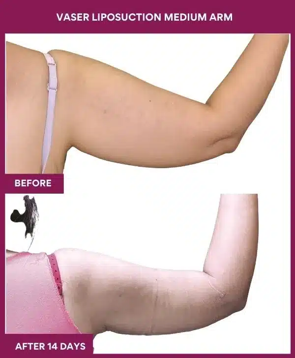 16 VASER LIPOSUCTION MEDIUM ARM-