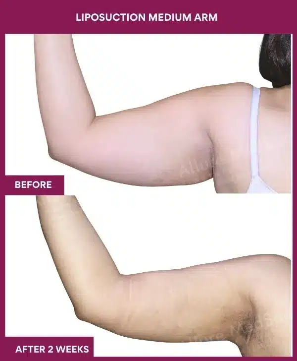 17 LIPOSUCTION MEDIUM ARM