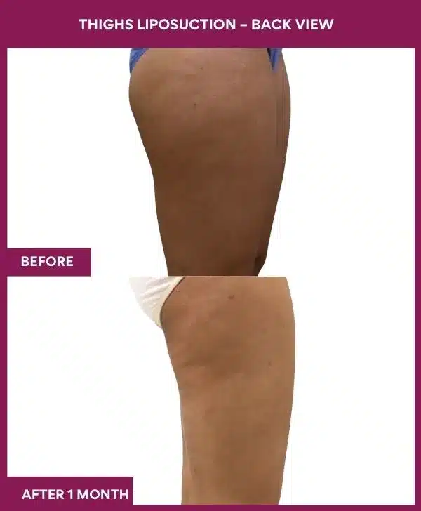 18 Thighs Liposuction – Back View-