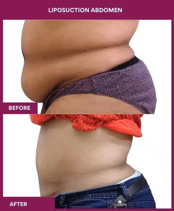 2- liposuction abdomen--
