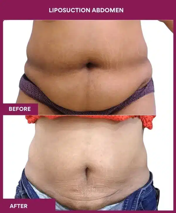 2- liposuction abdomen
