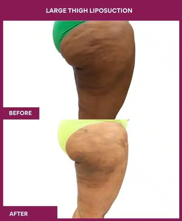 22 Large Thigh Liposuction--