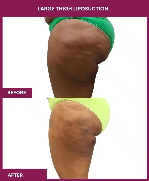 22 Large Thigh Liposuction-