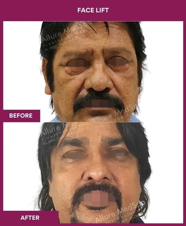 1 FACE LIFT_3_ (1)
