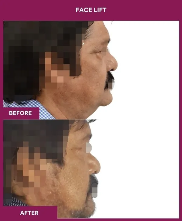 1 FACE LIFT_3_ (2)