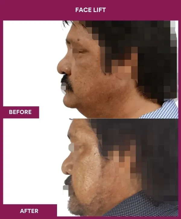 1 FACE LIFT_3_ (3)
