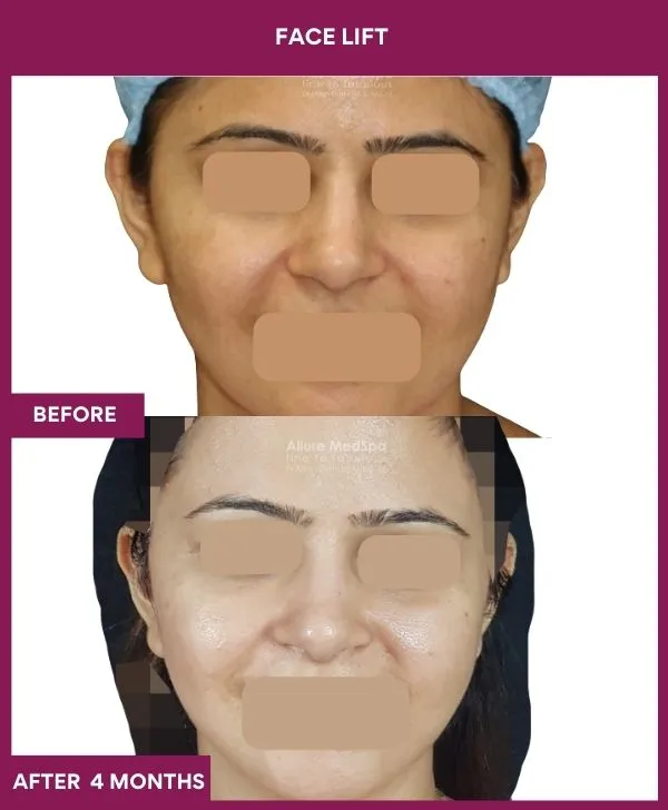 11 FACE LIFT (4)_25_