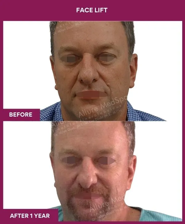 2 FACE LIFT_4_
