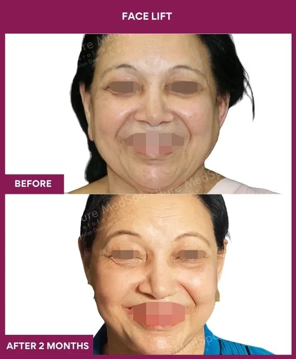 4 FACE LIFT_9_ (1)