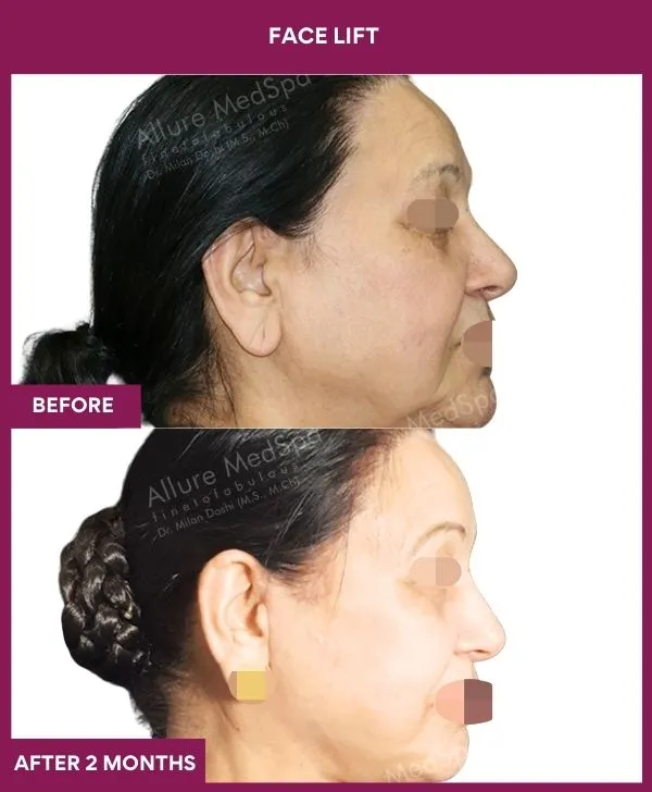 4 FACE LIFT_9_ (2)