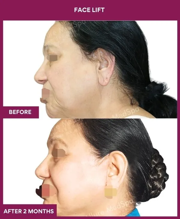 4 FACE LIFT_9_ (3)
