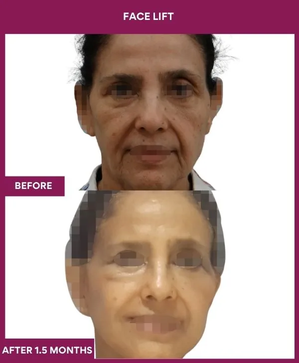 5 FACE LIFT_11_ (1)