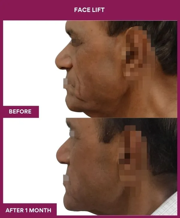 6 FACE LIFT (3)_13_