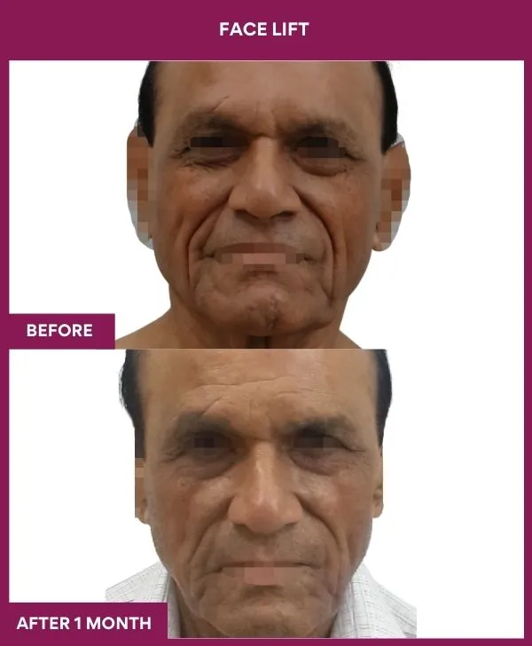 6 FACE LIFT (4)_13_