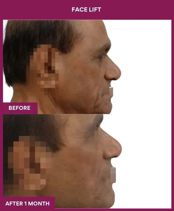6 FACE LIFT (5)_13_
