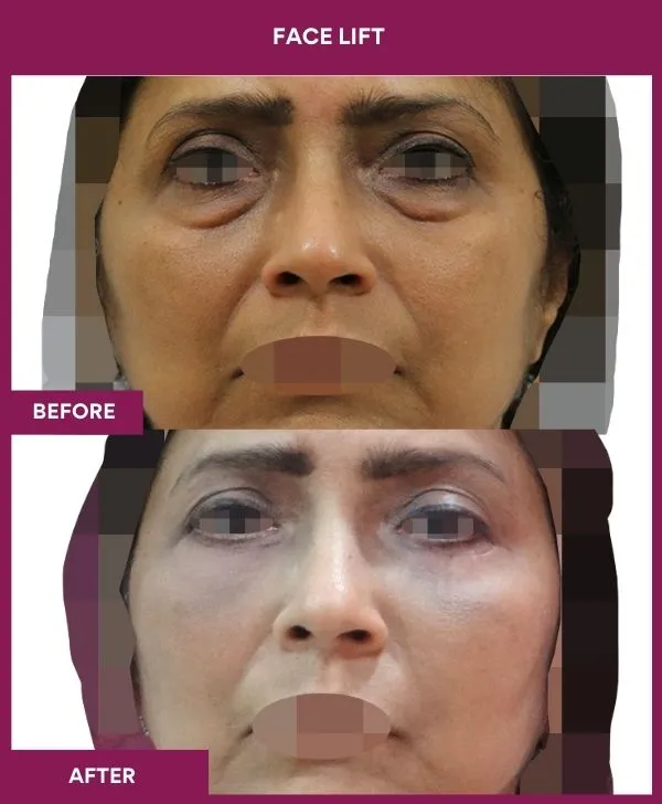 8 FACE LIFT_17_
