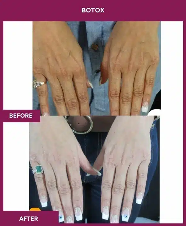 1 Botox (2)