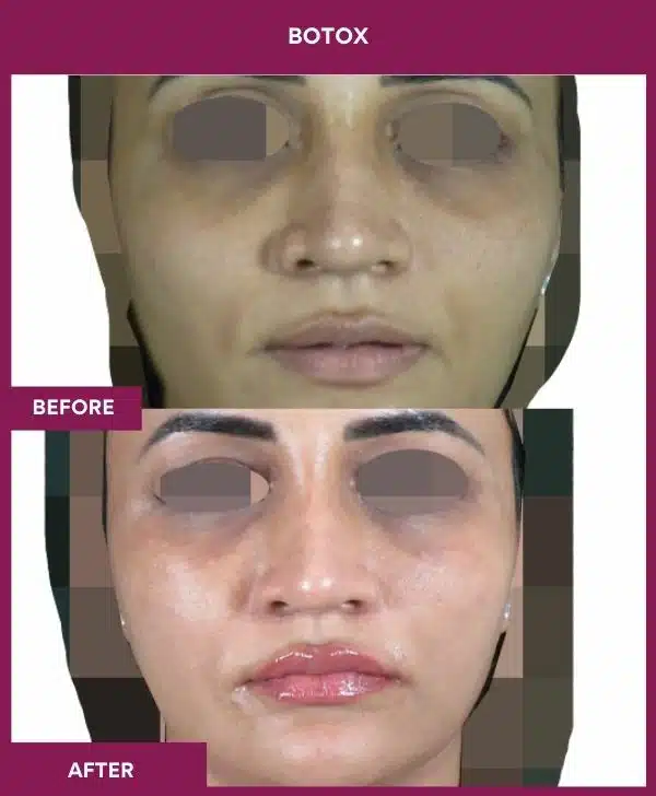 1 Botox (3)