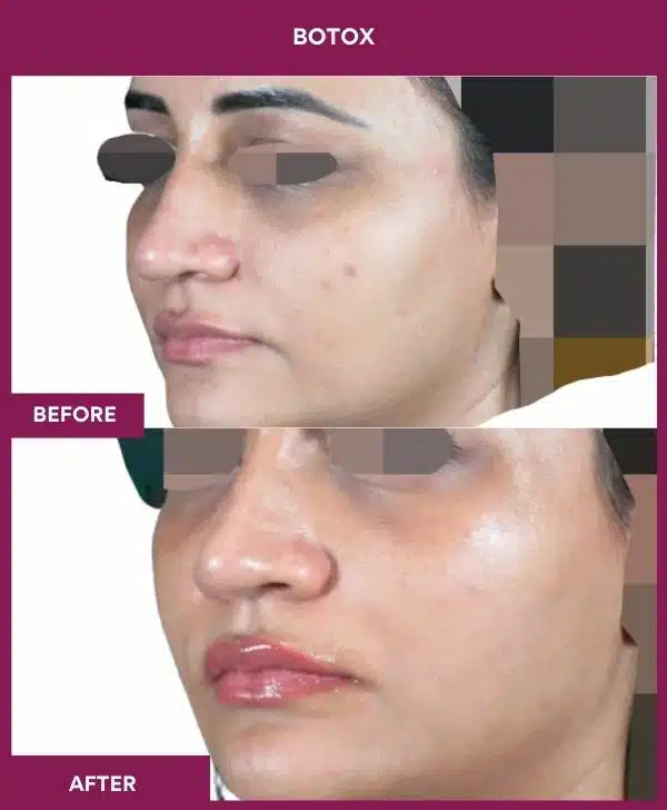 1 Botox (4)