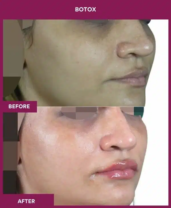1 Botox (5)