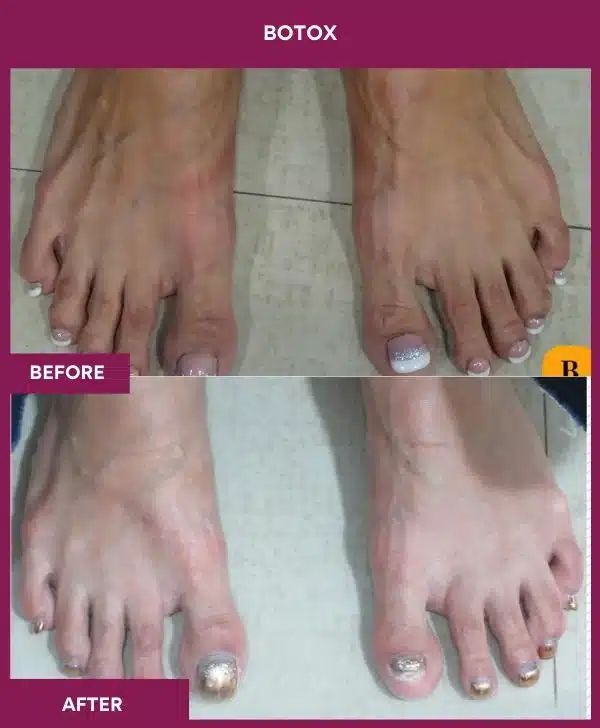1 Botox