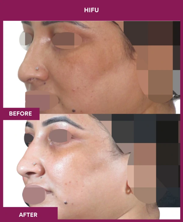 Hifu Treatment in Mumbai