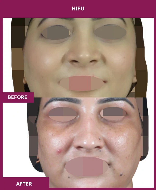 Hifu Treatment in Mumbai