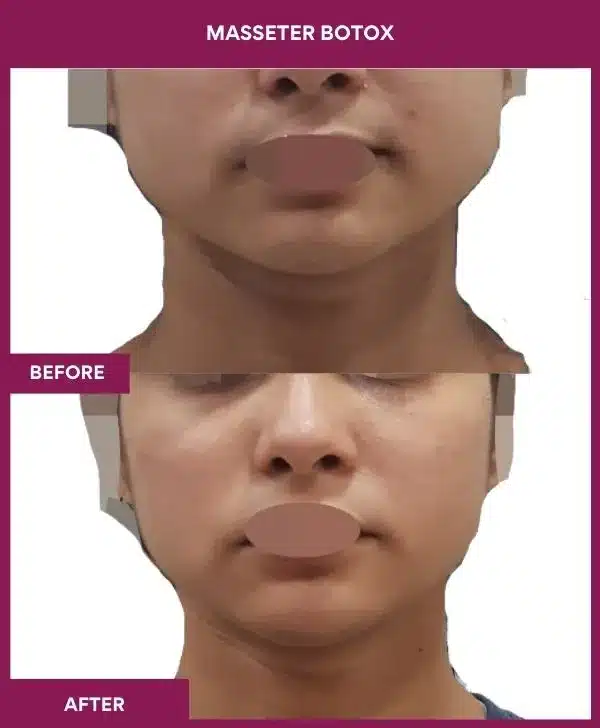 1 masseter botox (4)_2