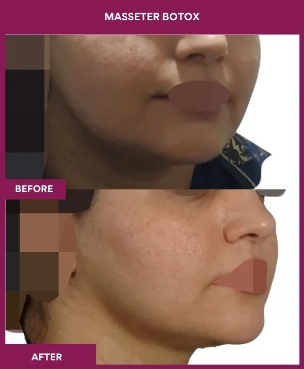 1 masseter botox (5)_2