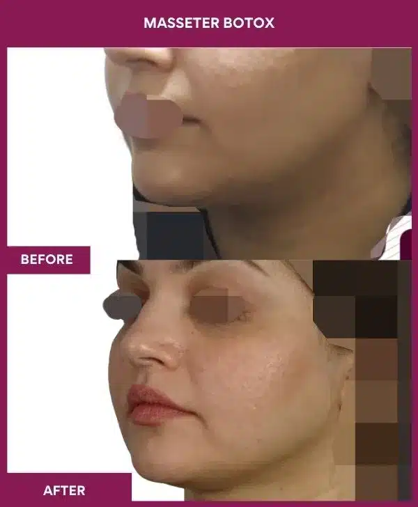 1 masseter botox (6)_2