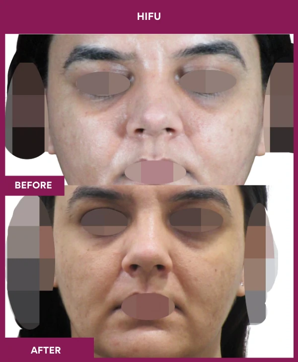 Hifu Treatment in Mumbai