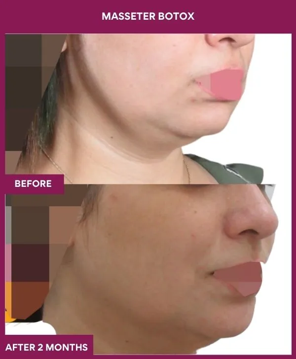 2 masseter botox (3)_4_