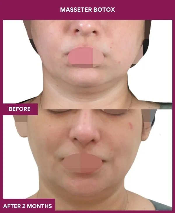 2 masseter botox (4)_4_