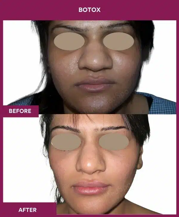 3 Botox