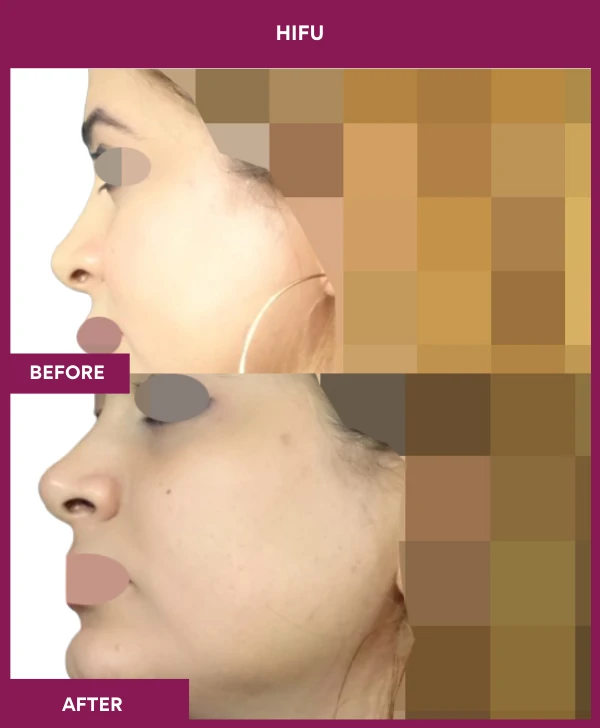Hifu Treatment in Mumbai