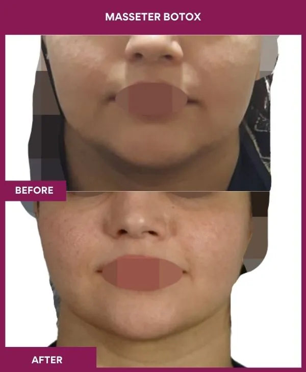 3 masseter botox_3_
