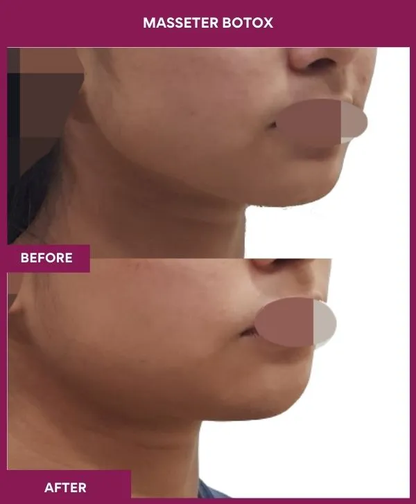 3 masseter botox_8 (2)