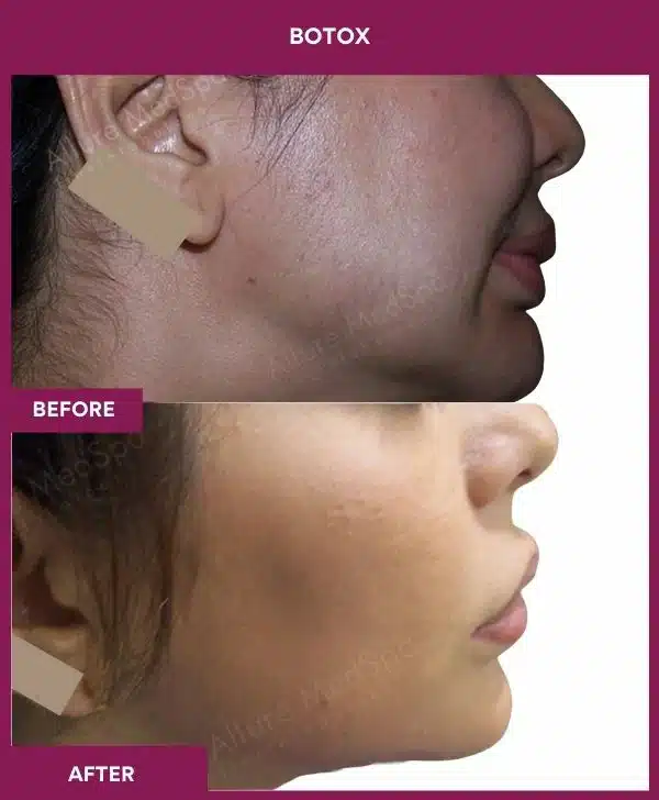 4 Botox (2)