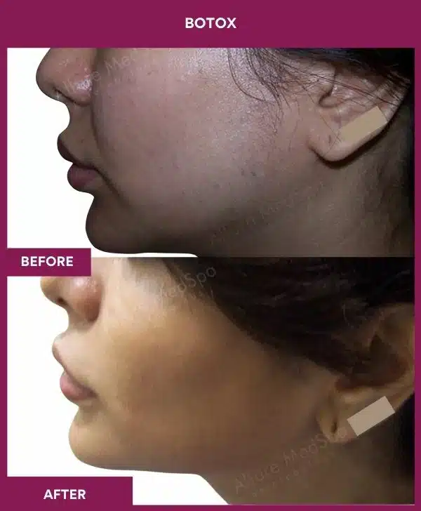 4 Botox (3)