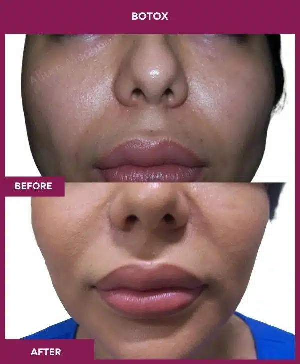4 Botox